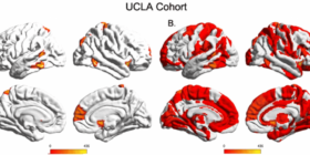 Qual é a origem da psicose no cérebro? IA ajudou a descobrir