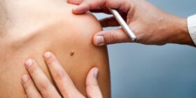 Como funciona a nova vacina contra o câncer de pele