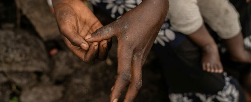 Mpox: regulador recomenda alargar vacinação a adolescentes