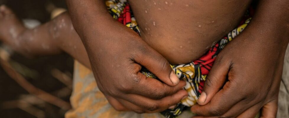 Mpox já matou 866 pessoas em África desde o início do ano